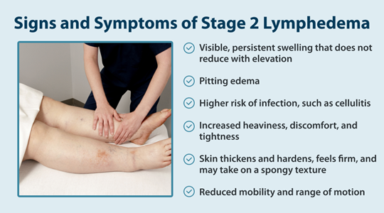 Signs and Symptoms of Stage 2 Lymphedema -Visible, persistent swelling that does not reduce with elevation -Pitting edema -Higher risk of infection, such as cellulitis -Increased heaviness, discomfort, and tightness -Skin thickens and hardens, feels firm, and may take on a spongy texture -Reduced mobility and range of motion